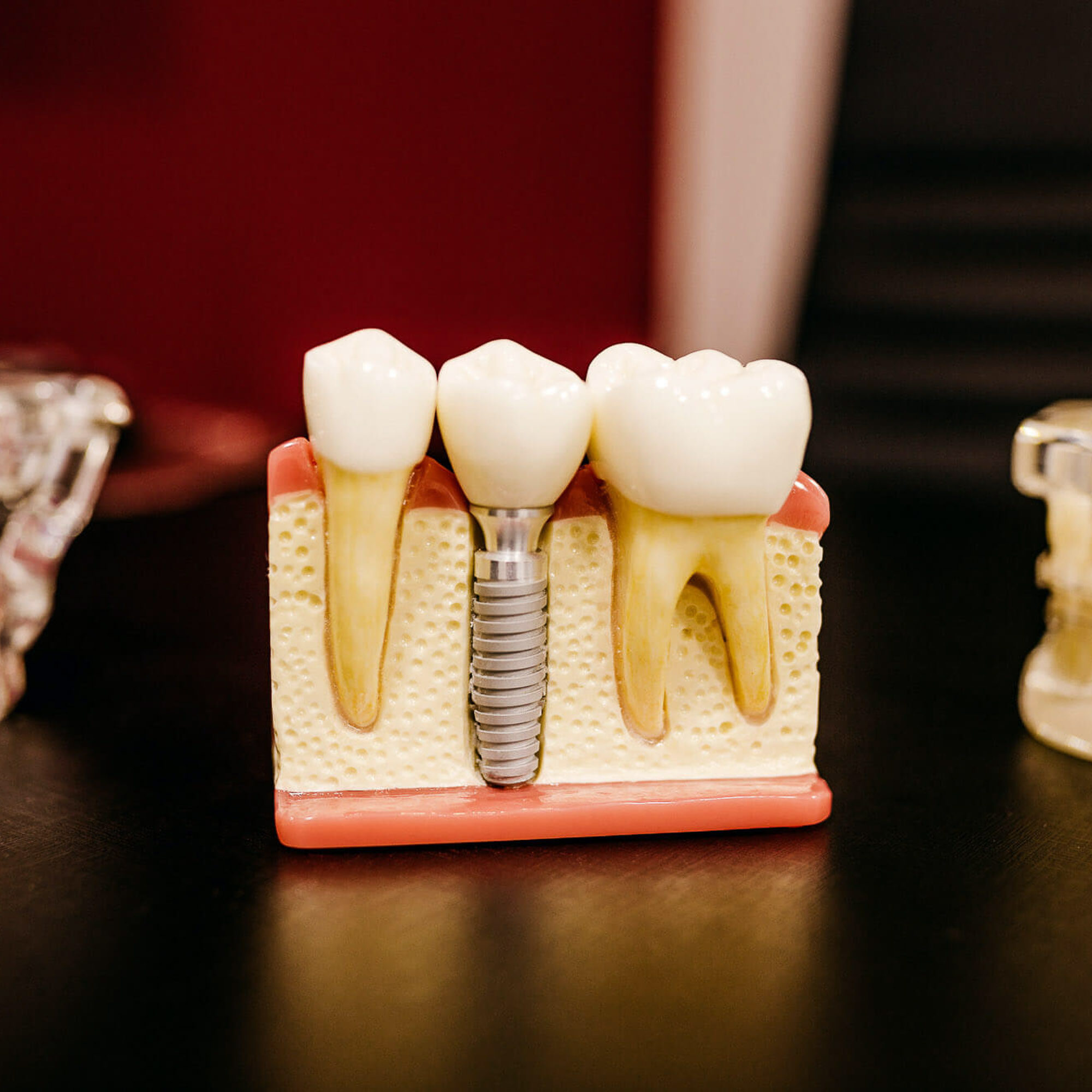Dental Implantssmallsmall model of dental implants